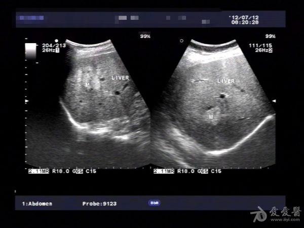 发现十多年的肝脏多发性血管瘤. - 超声医学讨论版