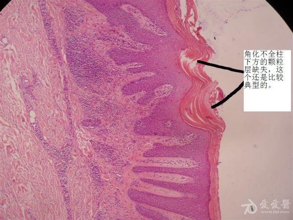 看图诊断-答案已给出-汗孔角化症!