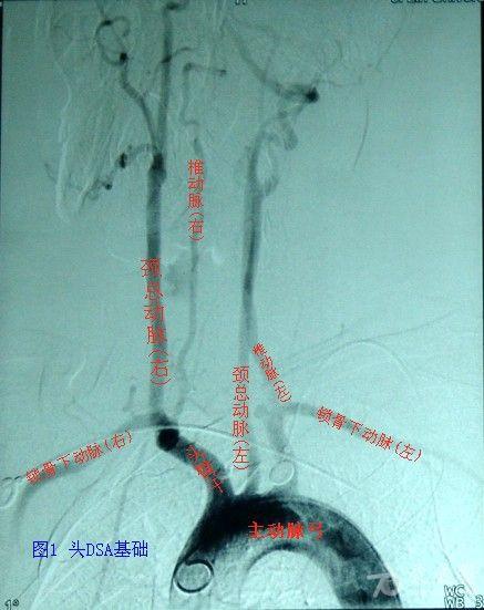 【从血管看疾病】专题之一 全脑血管造影术(dsa)基础