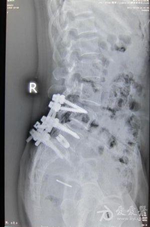 腰5椎体前滑脱术后断钉(如何处理?
