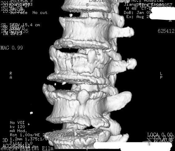 腰3椎体骨折