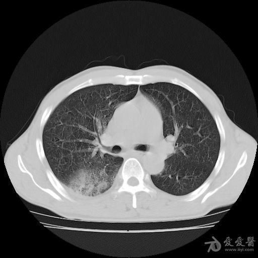 尘肺结节?肺tb?炎性病变(霉菌)?占位? - 医学影像学版