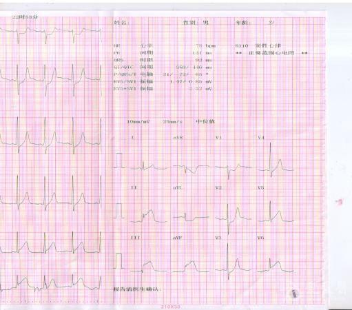 78例超声心动图结果分析图1 心电图st改变仅有Ⅲavf是什么意思答