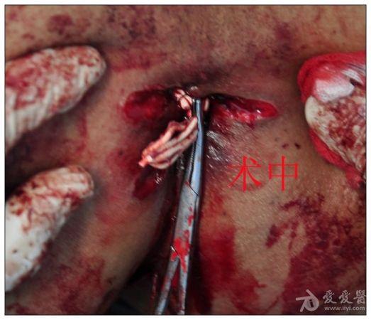 低位肛瘘术前术后照