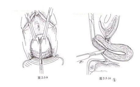 手术难点技巧图解二:经阴道全子宫切除术(一)