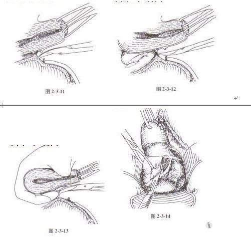 手术难点技巧图解二:经阴道全子宫切除术(一)