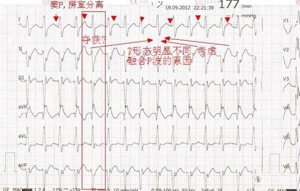 云的影子宽qrs呈crbbb形态 lafb形态,电轴左偏,v5,v6导联rs型,avr
