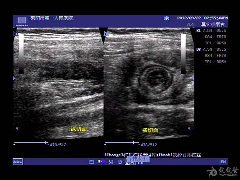 肠套叠(超声 x线图)
