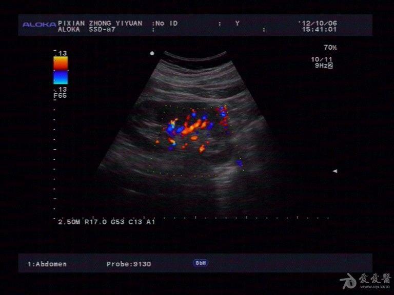 重复肾 超声医学讨论版 爱爱医医学论坛 爱爱医医学网