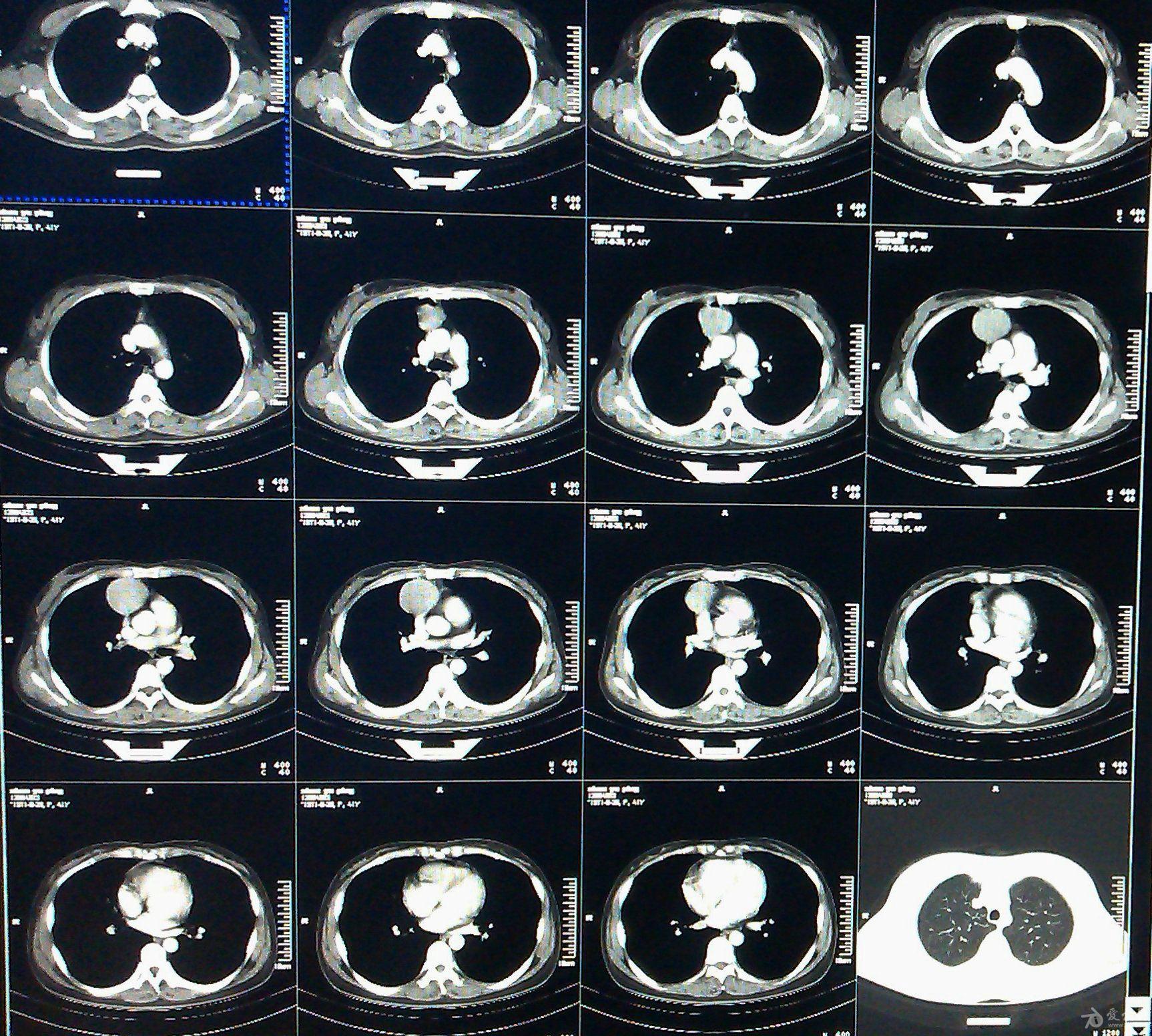 男36岁,3月份体检ct发现肺部小结节2mm,医院建议3个月