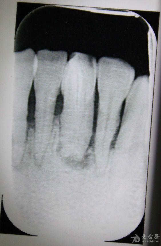 牙龈瘘管 黄白色脓液 牙髓科医生建议拔牙 圣人救救我!