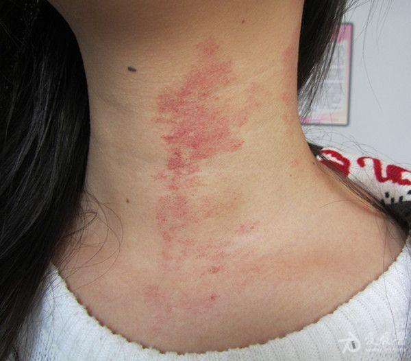 女孩颈部红斑 鲜红斑痣