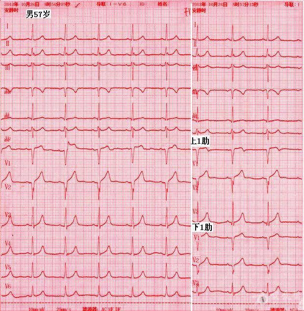 又一例v1,v2导联qs波心电图
