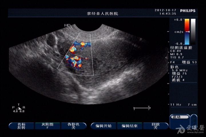 子宫动静脉瘘一例 超声医学讨论版 爱爱医医学论坛 爱爱医医学