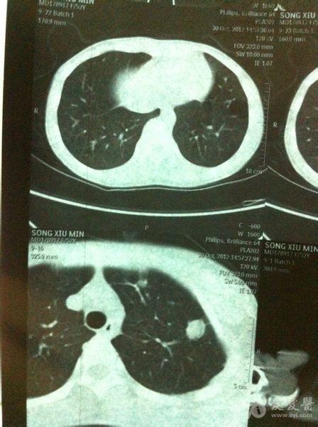 人得,没治疗过,突然被查出:双侧胸廊对称,左肺尖见小片状软组织密度影