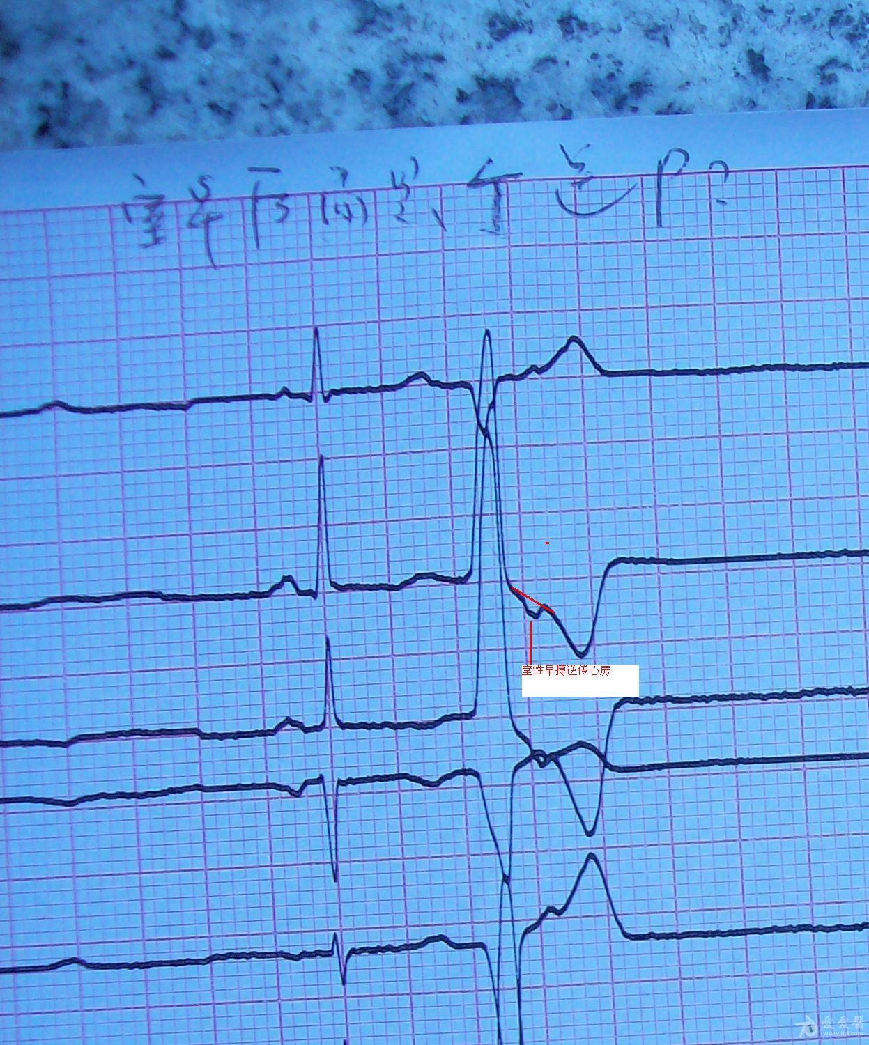 室性早搏? 交界性早搏?