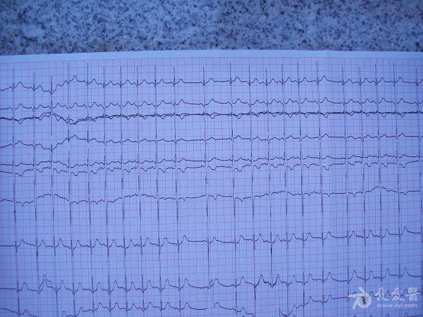 小儿心电图