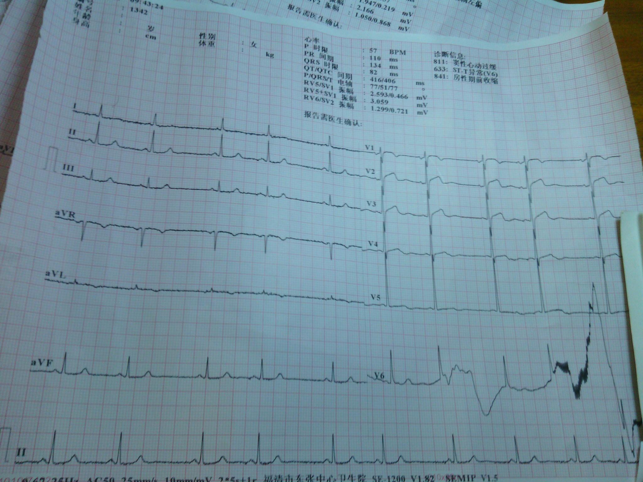 这是房早还是窦性心律不齐 心电图脑电图专业讨论版 爱爱医医学