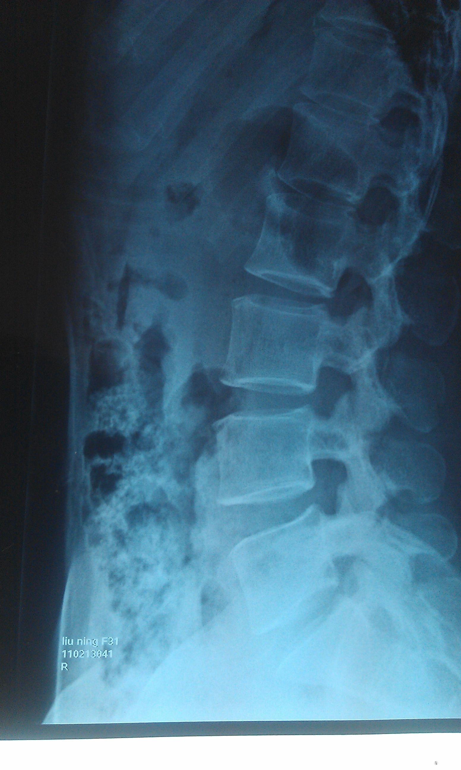 求会看x光片的大师们给看看这腰椎片有什么问题