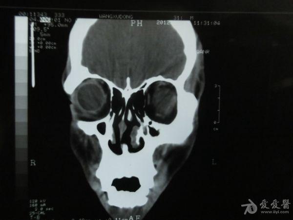 副鼻窦ct轴位 冠状位平扫,请各位专家帮忙看下,万分感谢!