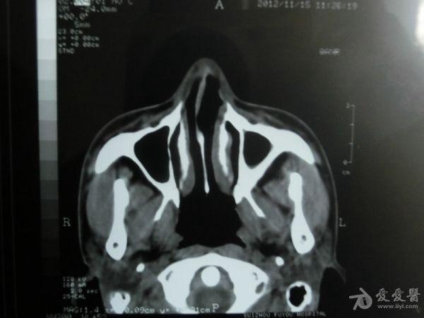 副鼻窦ct轴位 冠状位平扫,请各位专家帮忙看下,万分感谢!