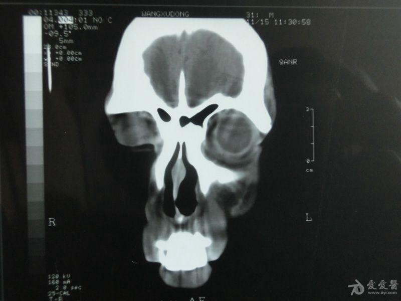 副鼻窦ct轴位 冠状位平扫,请各位专家帮忙看下,万分感谢!