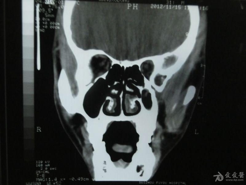 副鼻窦ct轴位 冠状位平扫,请各位专家帮忙看下,万分感谢!