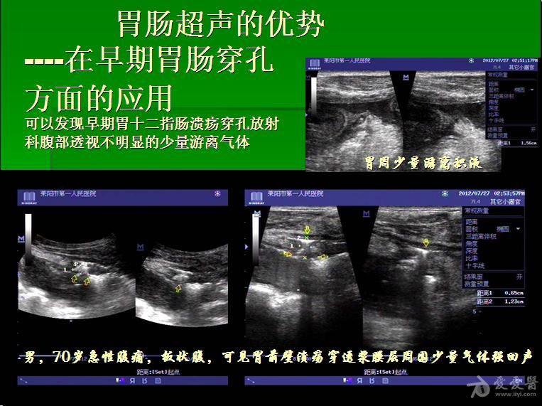 板状腹病人  超声发现残胃前壁溃疡穿孔,周围少理游离积液和线样气体