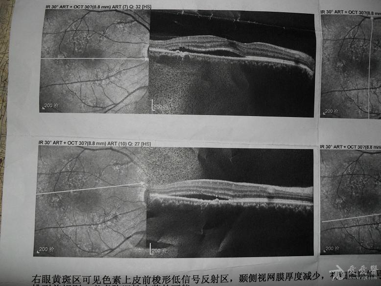 右眼陈旧性中浆?