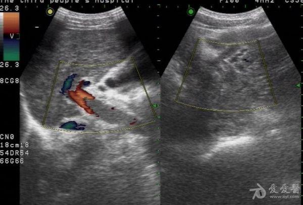 门静脉实性占位 - 超声医学讨论版 - 爱爱医医学论坛