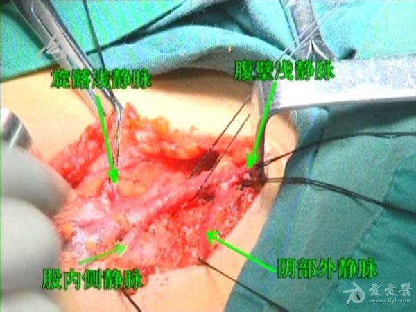 【高清dvd手术视频】-大隐静脉曲张高位结扎抽剥术1,2