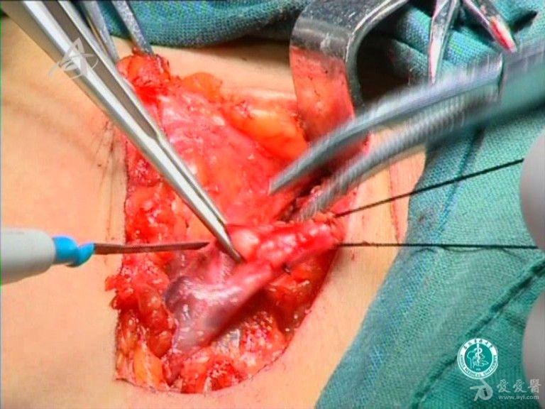 【高清dvd手术视频】-大隐静脉曲张高位结扎抽剥术1,2