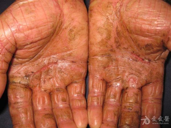 这是什么皮肤病-慢性接触性皮炎