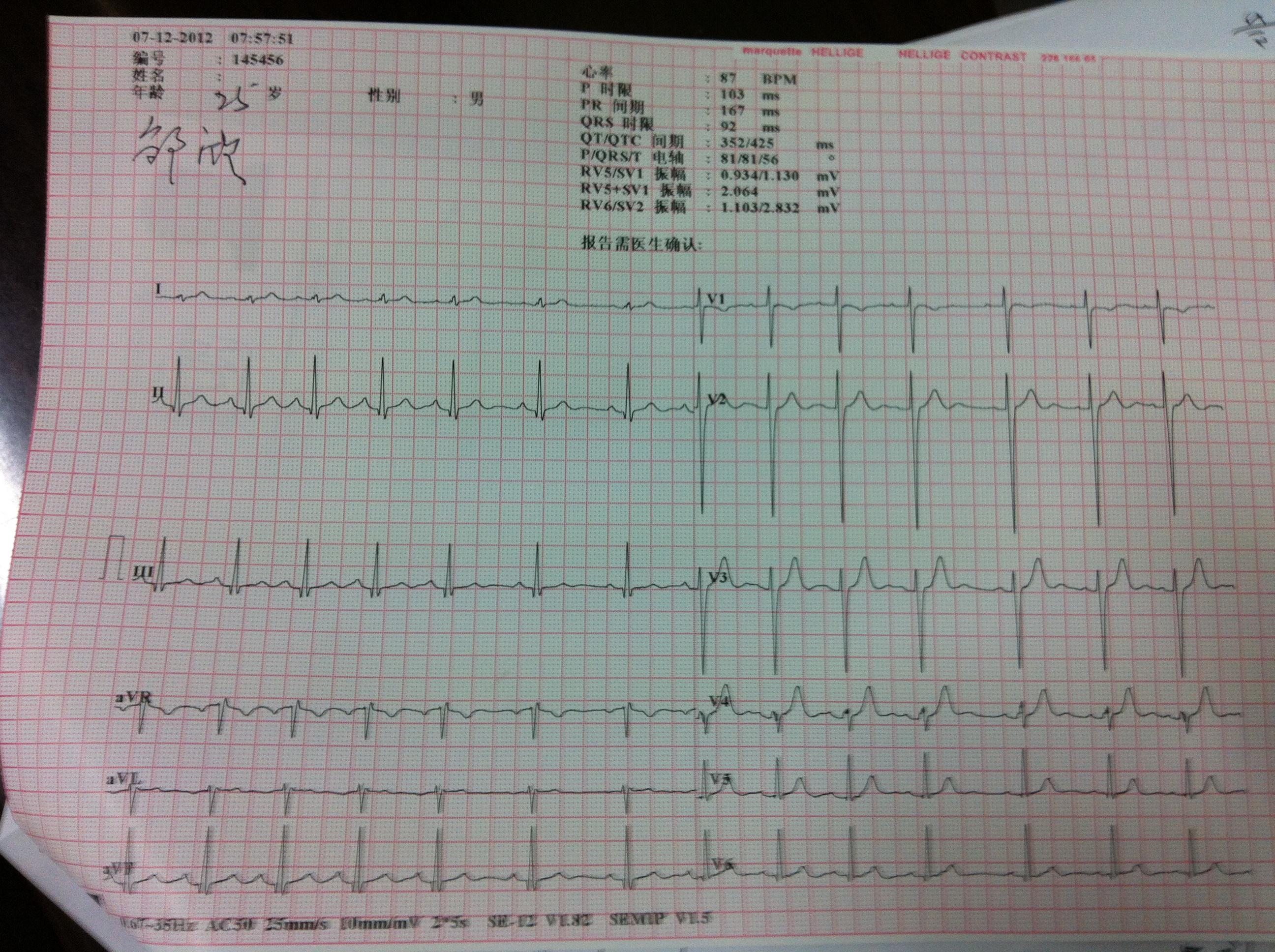 今天入职体检,做了心电图,能帮我看看有没问题吗?