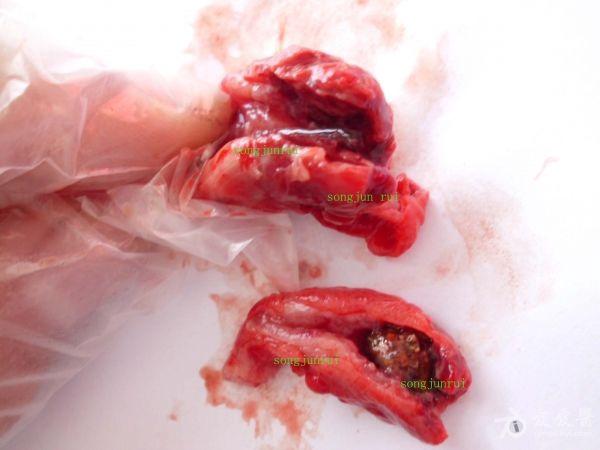 急性化脓性阑尾炎伴腔内粪石,周围大网膜包裹,淋巴结肿大(超声 手术
