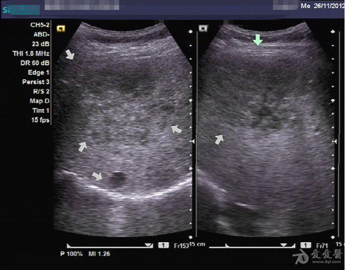 上个月碰到的一例肝血管瘤 - 超声医学讨论版 - 爱爱