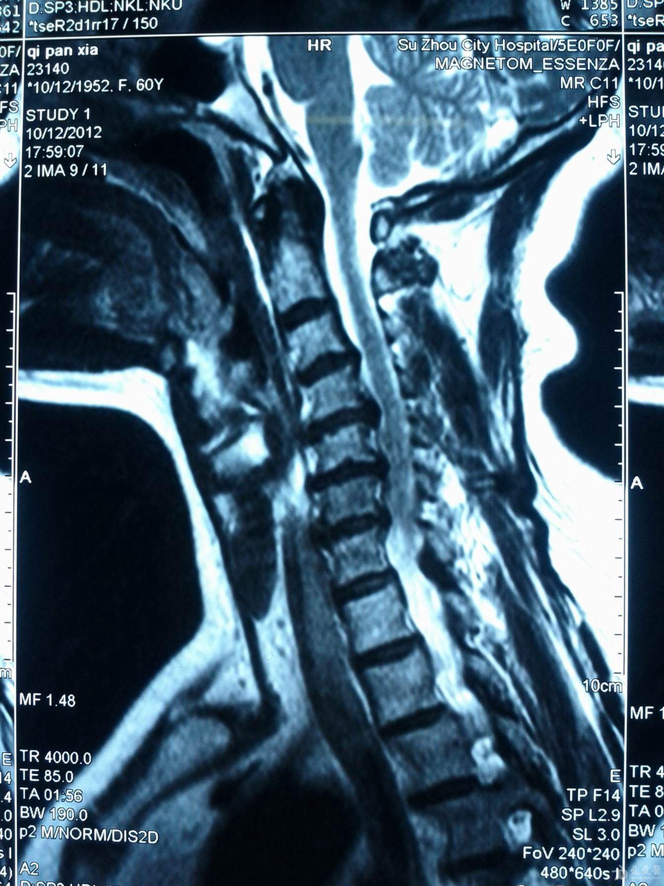 mri 第六椎体血管瘤?请大家分析.