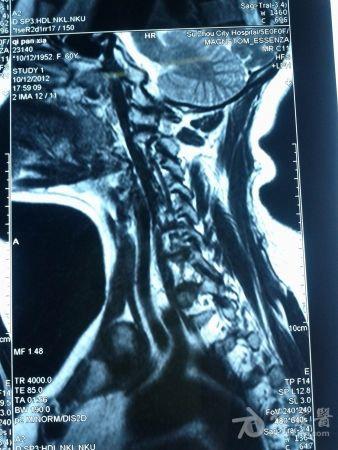 MRI 第六椎体血管瘤?请大家分析。 _ 医学影像