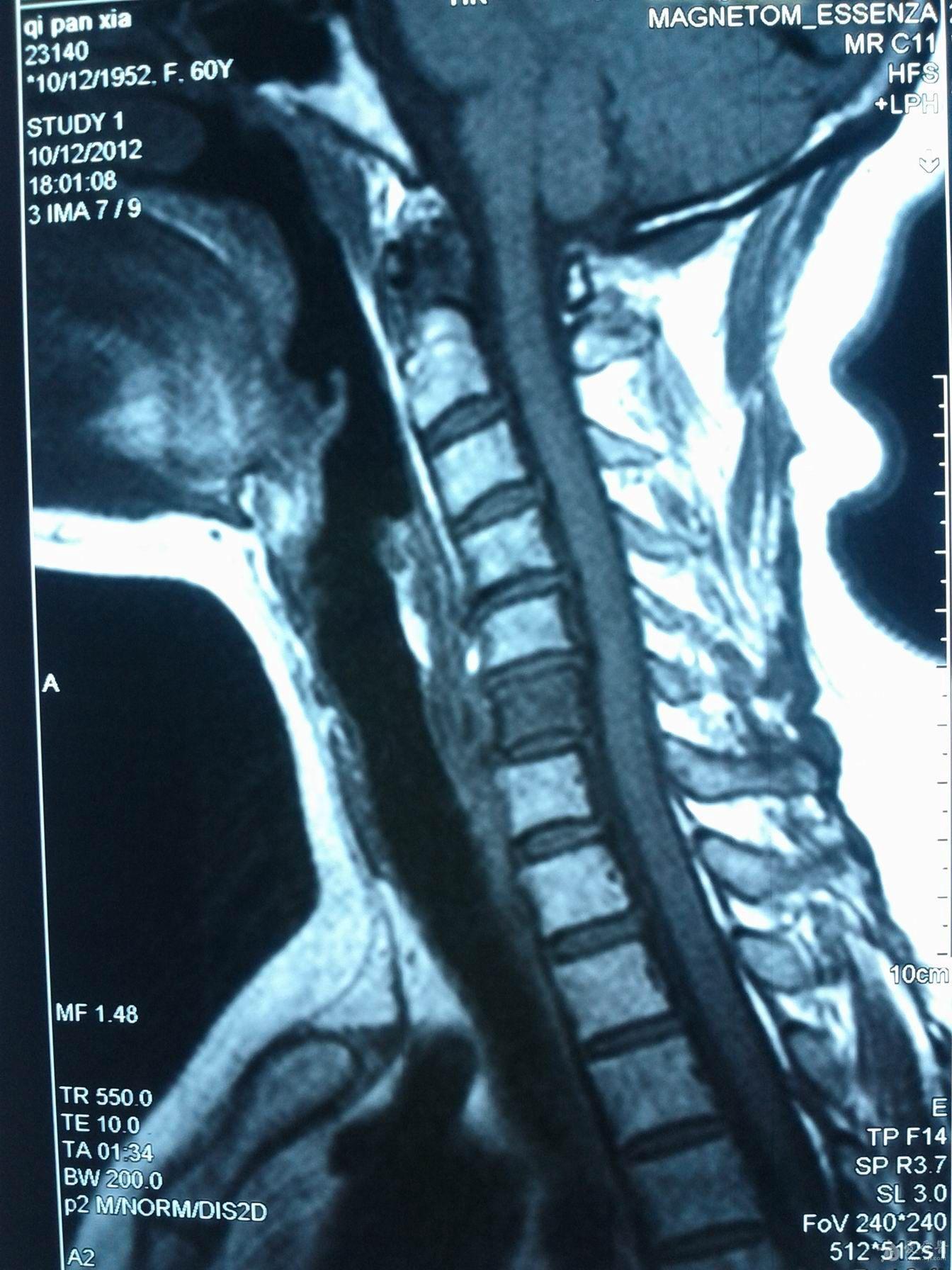 mri 第六椎体血管瘤?请大家分析.