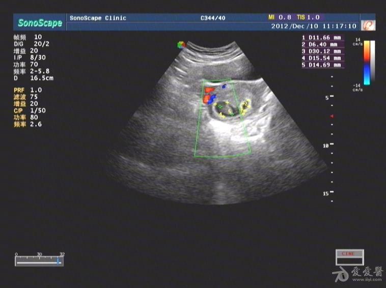 孕囊旁是什么 超声医学讨论版 爱爱医医学论坛 爱爱医医学网