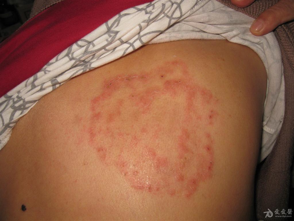 1月前背部有一痒疹,自用皮炎平外擦,结果越擦越大,今日来诊,皮屑直接