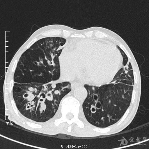 典型支气管扩张及肺水肿ct片
