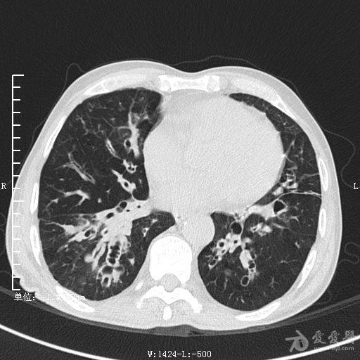 典型支气管扩张及肺水肿ct片