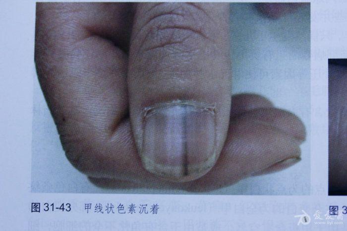 是甲母痣还是色素沉淀?求高手!