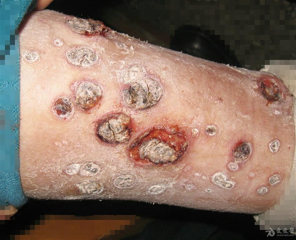 这是什么皮肤病------变应性血管炎