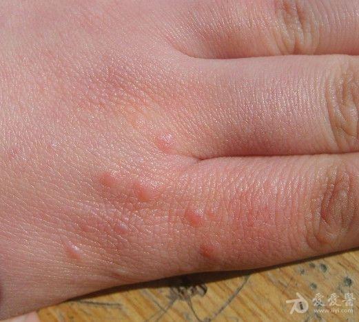 手背的丘疹—疣状肢端角化病
