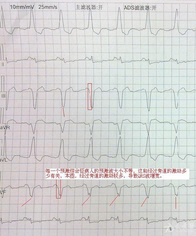 6楼回复trg典型预激综合征b,  每一个预激综合征病人的预激波大小不