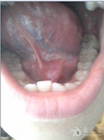 诊所轶事之十一:舌下腺炎性囊肿 ?