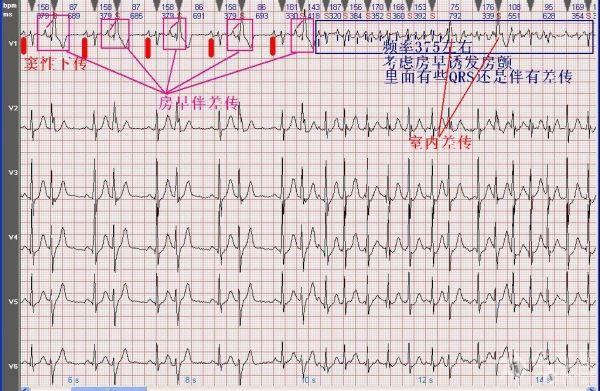 电轴左偏  房性早搏(部分呈二联律,三联律)  短阵房速  室性早搏  房