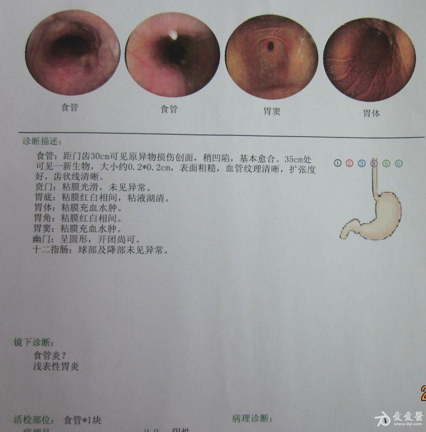 鱼刺穿透食管壁刺入心脏一例